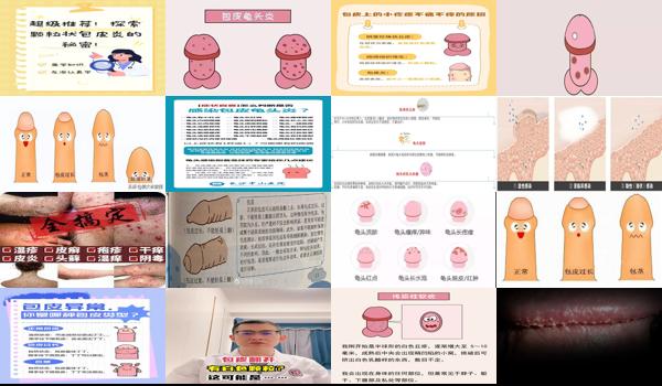 包皮长颗粒怎么办 - 汕头包皮长颗粒