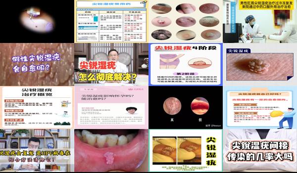 尖锐湿犹医的好吗 - 汕头尖锐湿尤会自愈吗
