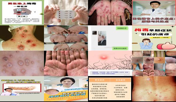 如何判断男生得了梅毒 - 汕头如何判断男生中了梅毒