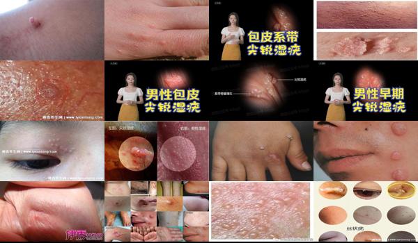 汕头*可靠的皮肤科医院 - 汕头尖锐湿疣图片男性初期图片