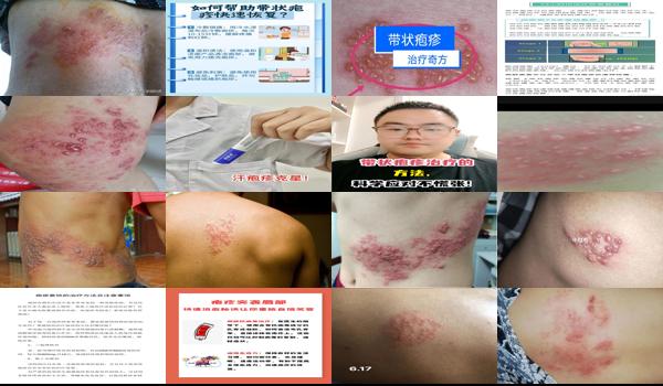 汕头怎么治 - 汕头治疗疱疹的*好方法