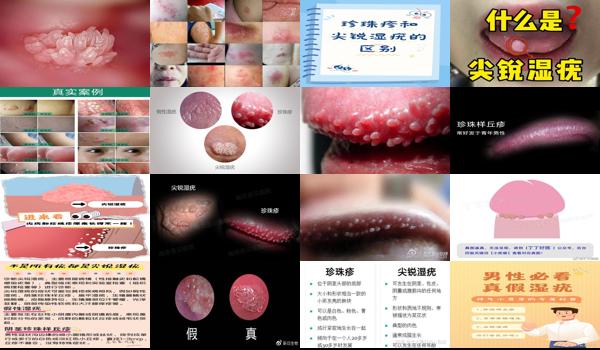 珍珠疹与尖锐湿疹区别有那些 - 汕头珍珠疹和尖锐湿疣区别