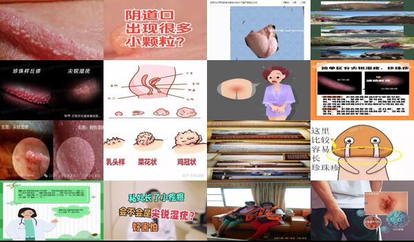 下体有小疙瘩是尖锐吗 - 汕头下体长了很多小颗粒是尖锐