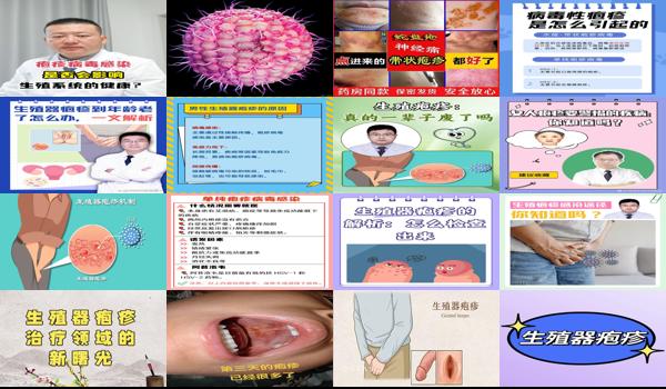 汕头生殖科医院 - 汕头生殖疱疹*能根治吗