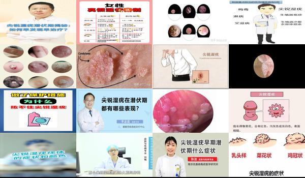 男性得了尖湿潜伏期能查到吗 - 汕头男性尖锐潜伏期怎么检查