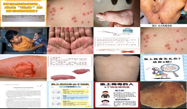 男人染上梅毒多久有症状? - 汕头男人染上梅毒一般多久开始腐烂