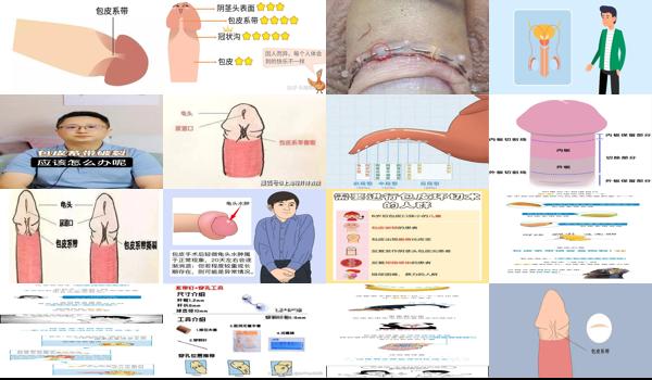 包皮系带断裂手术费用 - 汕头包皮系带断裂