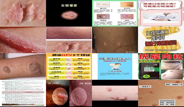 细长的肉疙瘩是尖锐 - 汕头长小肉粒*是尖锐湿疣么