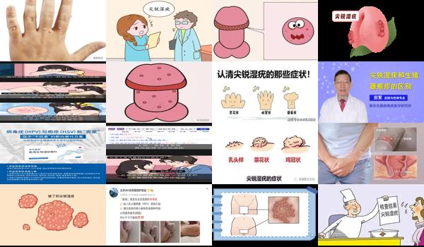 汕头生殖中心哪个医院哪个好 - 汕头生殖器尖锐湿庞图片