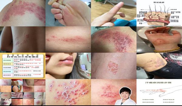 疱疹可以洗头洗澡吗 - 汕头疱疹能洗澡吗