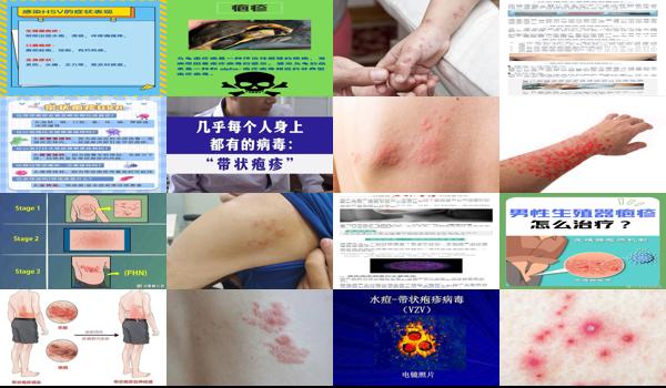 体内有疱疹*怎么办 - 汕头体内总有疱疹*怎么回事