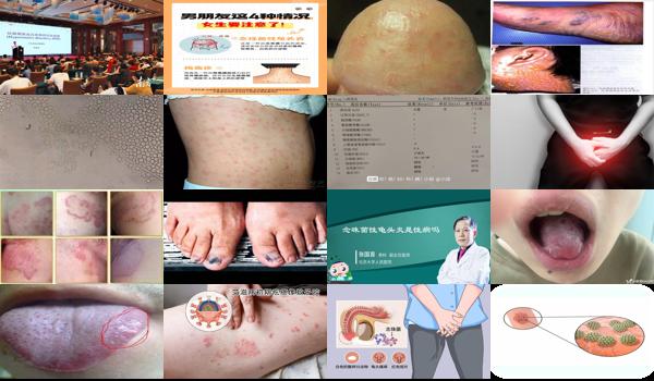 汕头男科医院哪家好 - 念珠菌男性感染 - 汕头男性念珠菌是梅毒吗