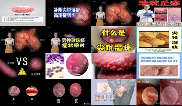 汕头男科医院 - 尖锐湿疣
