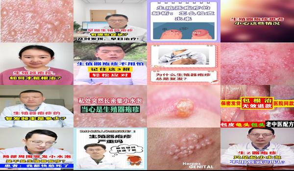 汕头男科医院 - 疱疹